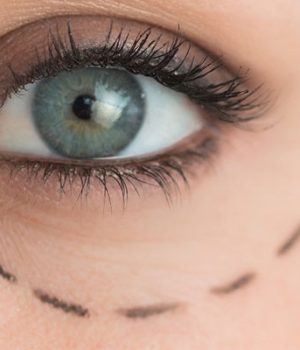 Wie wird eine Augenlidoperation durchgeführt?