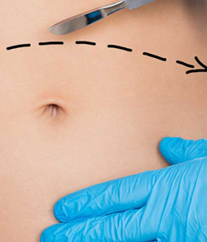 What are the Types of Abdominoplasty Surgery?