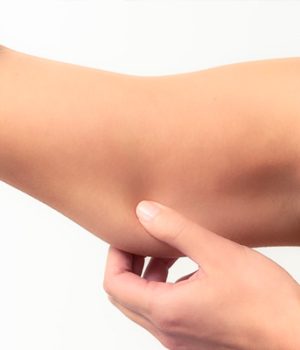 What You Need to Know About Arm Lift Surgery