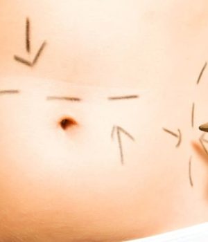 Why is Tummy Tuck needed?
