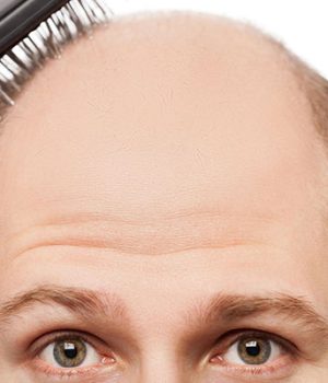 How are Hair Transplant Prices Determined?