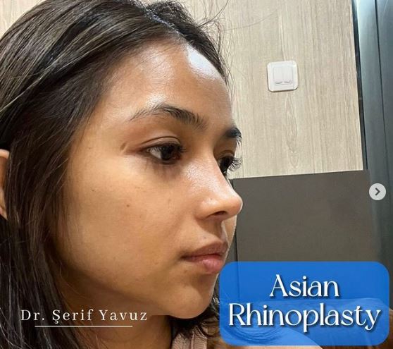 The 4th month result of #asianethnicrhinoplasty of our lovely patient from Indonesia
