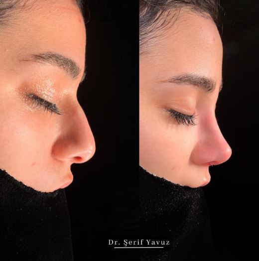 curvature was corrected, made slightly reduced and natural looking, feminine nose