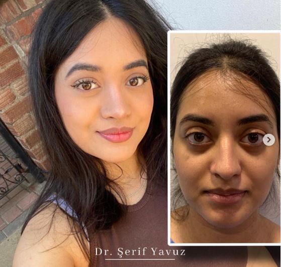 One year after rhinoplasty surgery of our dear patient from England