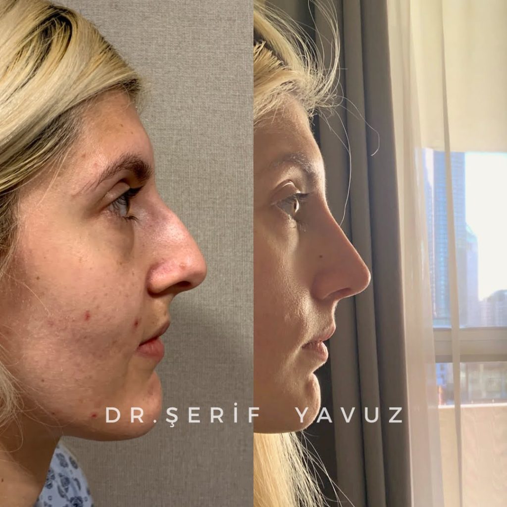 Rhinoplasty surgery istanbul before and after 3