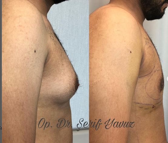 gynecomastia surgery turkey breast reduction turkey boob job istanbul