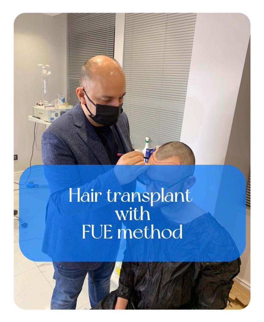 hair-transplant-turkey-before-and-after-cost-istanbul