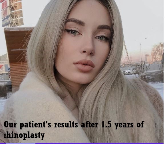 Rhinoplasty nose aesthtics surgery istanbul turkey 5
