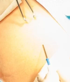 How to get rid of hanging belly after Cesarian / C-Section in Istanbul Turkey