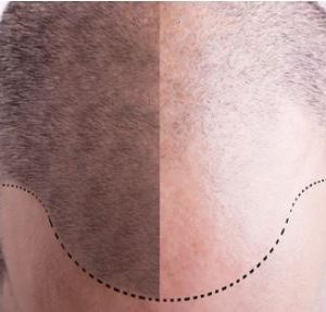 What are the Advantages of  FUE method of Hair Transplantation in Turkey, Istanbul