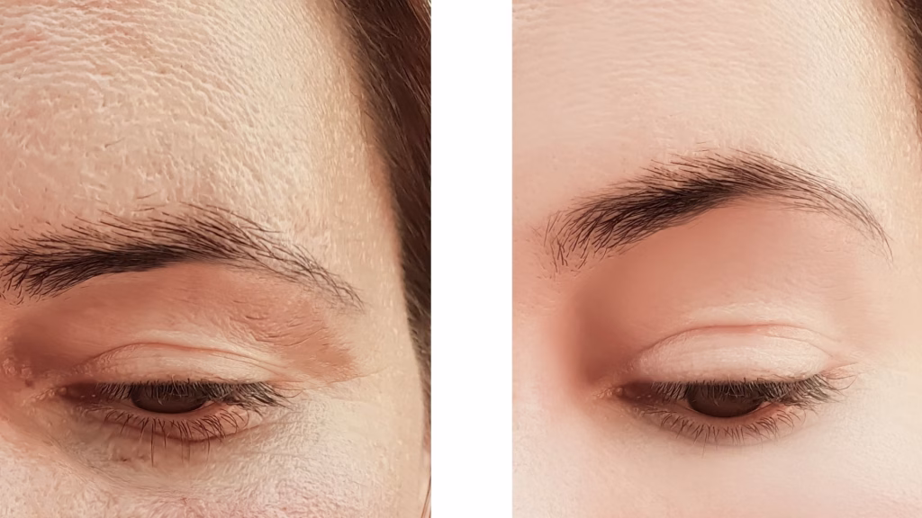 temporal-lift-turkey-before-after-1