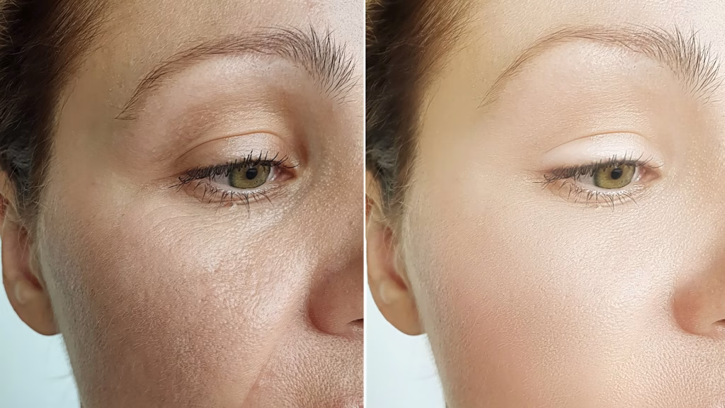 endoscopic-midface-lift-3