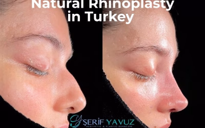 Is The New Rhinoplasty Trend Natural Rhinoplasty?