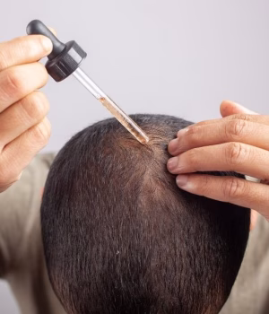 Minoxidil for Hair Loss: Does Minoxidil Work​?