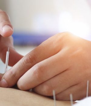 Иглоукалывание