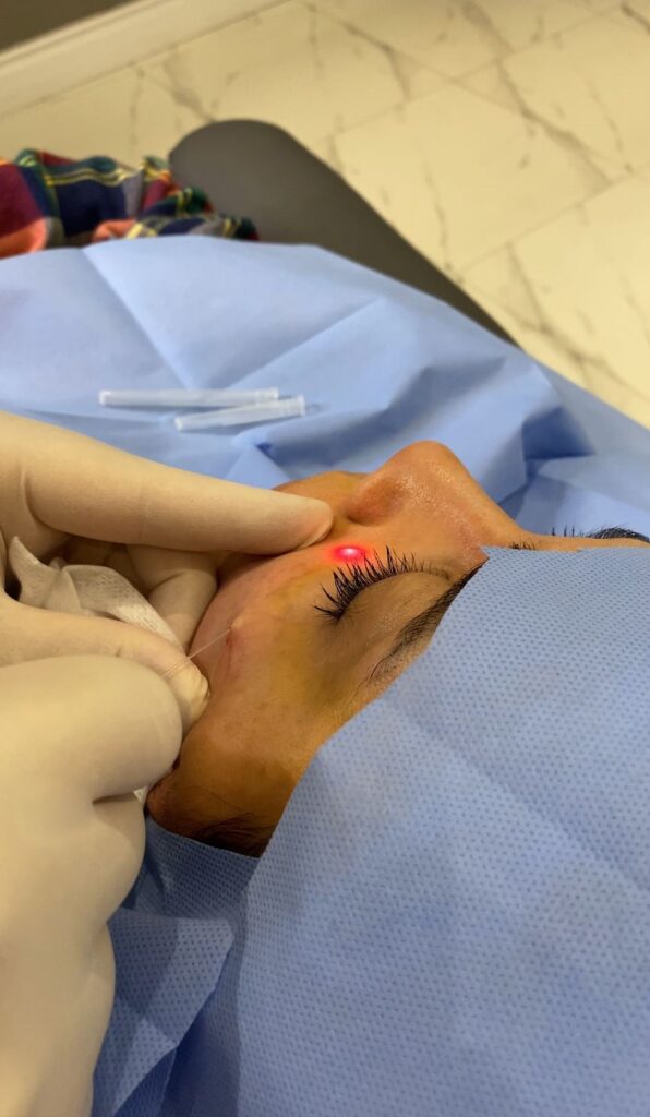 Endolift Lazer Nasıl Yapılır?